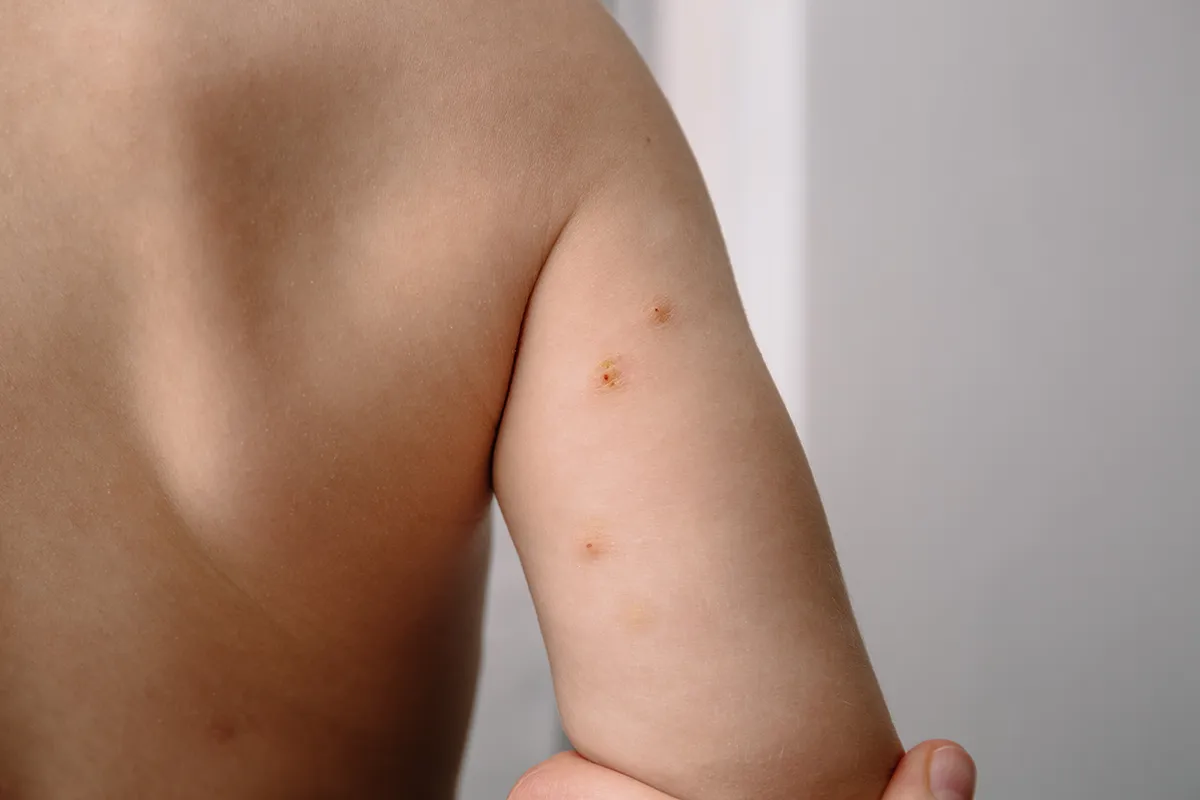 Molluscum Contagiosum sur la peau d'un enfant