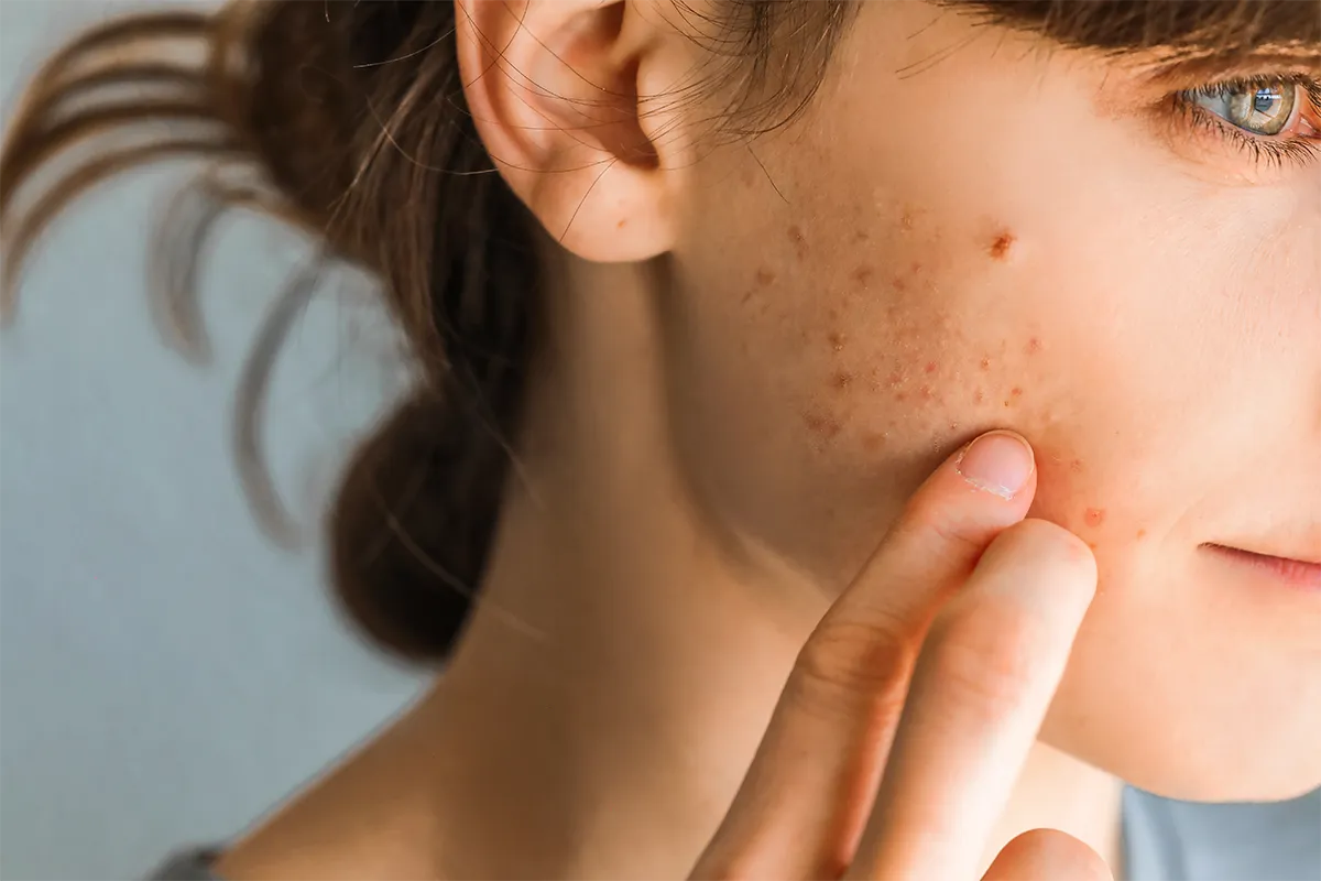 Adolescente touchant une zone d’acné sur sa joue.