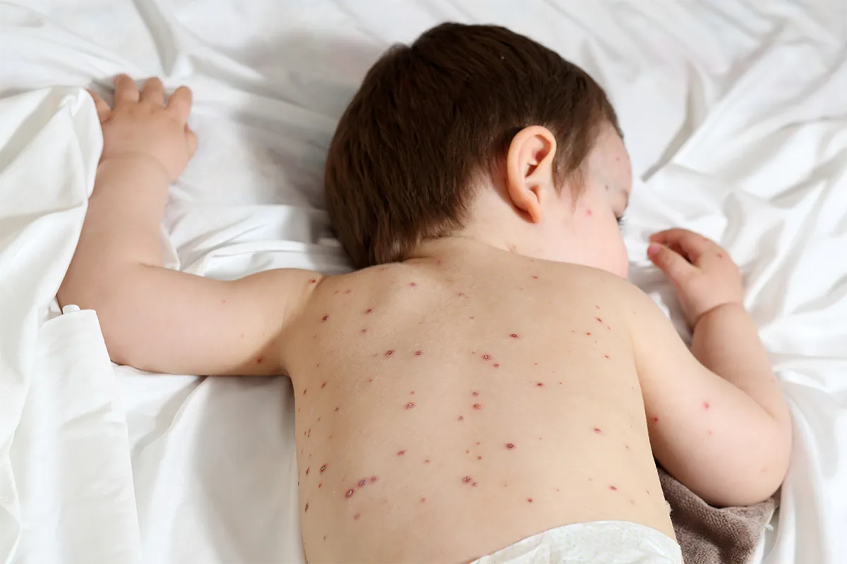 Enfant atteint de boutons rouges sur le dos, évocateurs de varicelle.