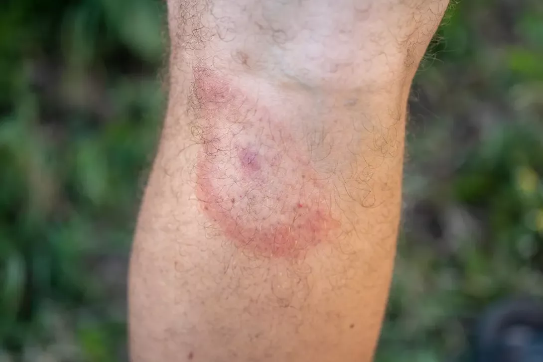 Rougeur cutanée sur la jambe pouvant évoquer une maladie de Lyme.